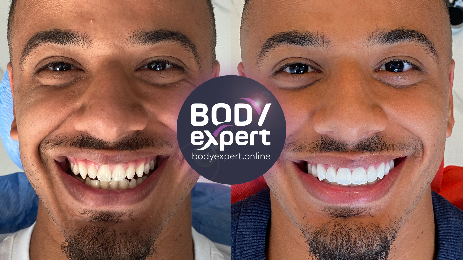 Before and after photographs of a male patient with a short beard: yellowed, uneven teeth, then a bright, aligned row