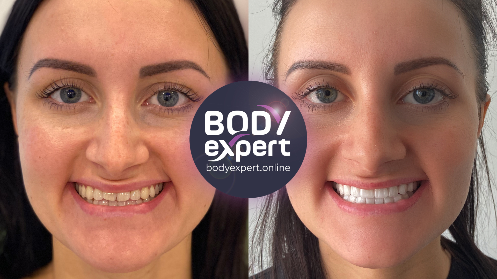 Before and after photographs of a light-eyed female patient with dark hair: narrow, irregular teeth, then an even, lighter row