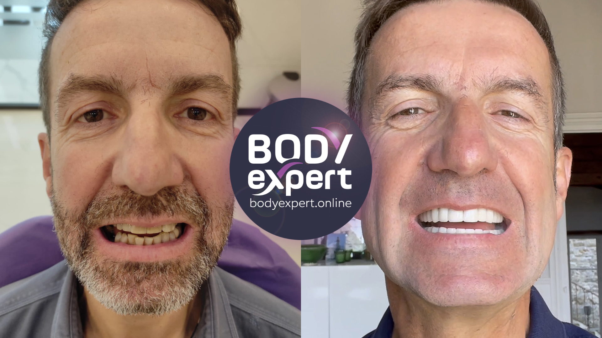 Before and after photographs of a greying male patient in a dental chair: badly worn and incomplete front teeth, then a complete row