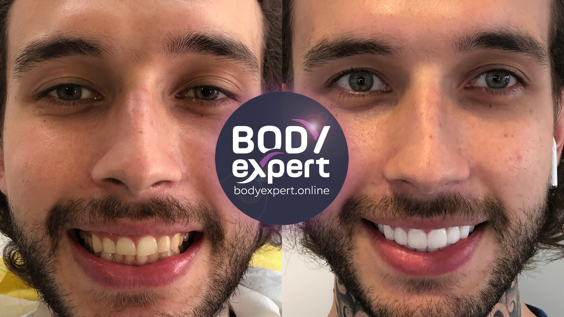 Before and after photographs of a young bearded male patient: yellowed, misaligned teeth, then a light, regular row