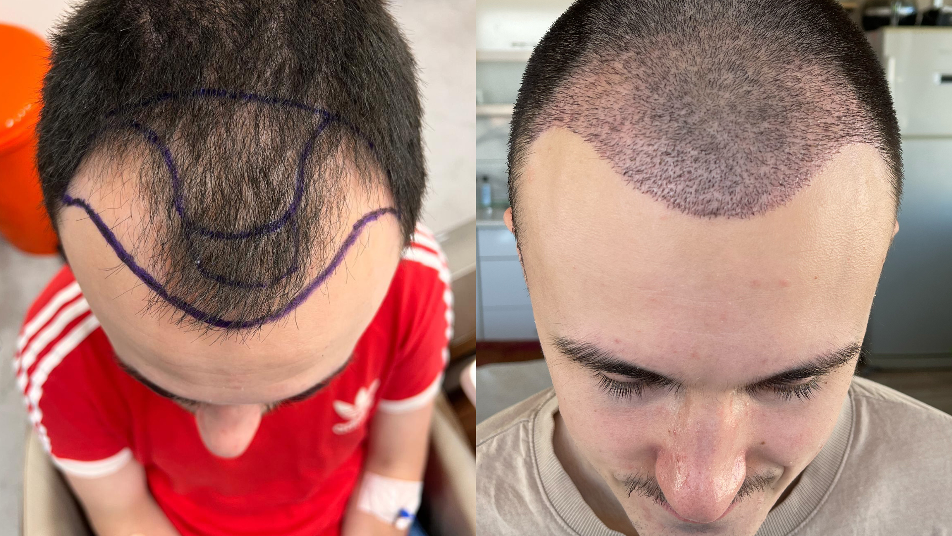 Deux vues du dessus d’un homme avec un tracé frontal puis une zone présentant de petits points