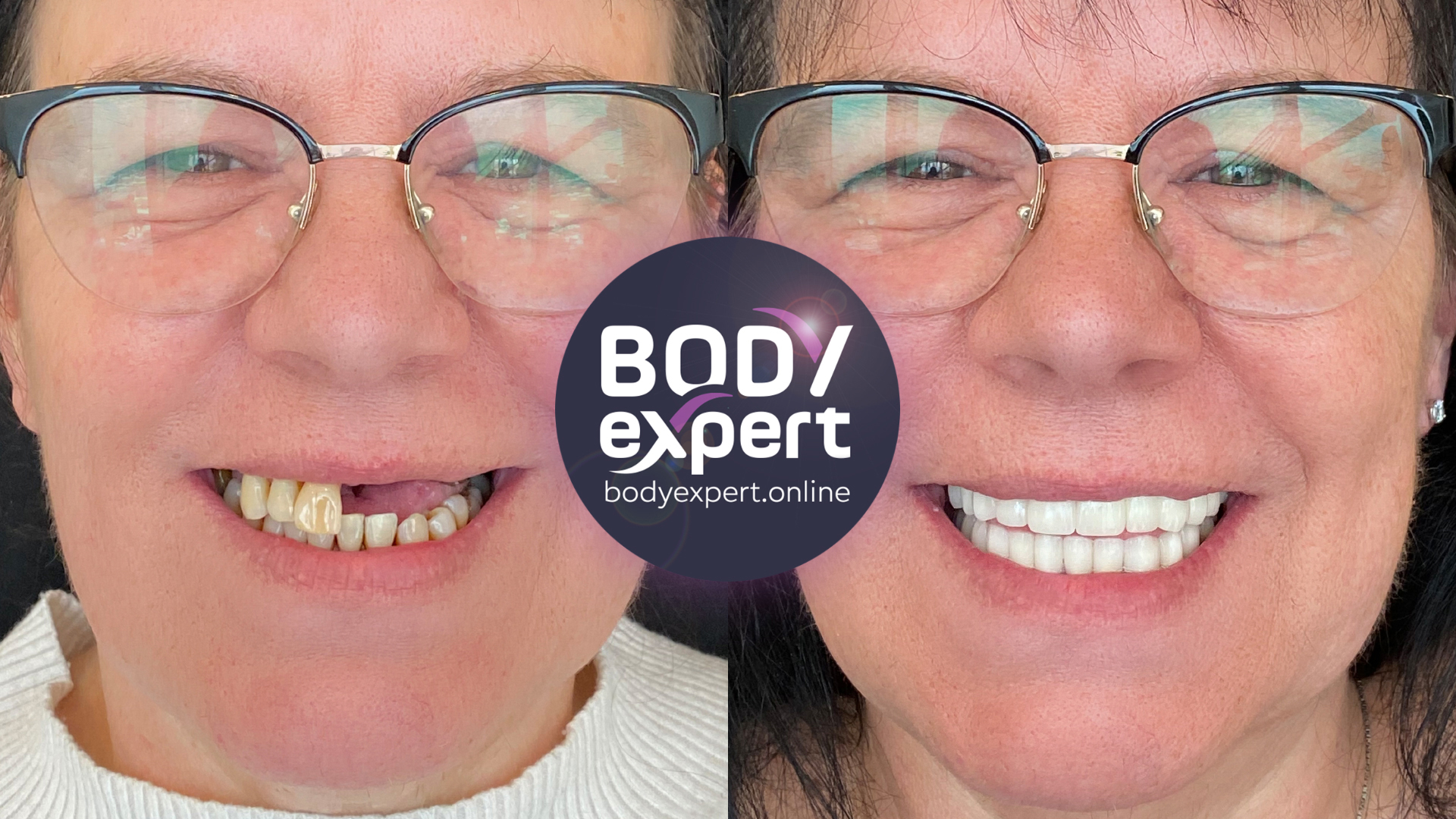 Before and after photographs of a female patient wearing glasses: a missing front tooth and worn teeth, then a complete smile