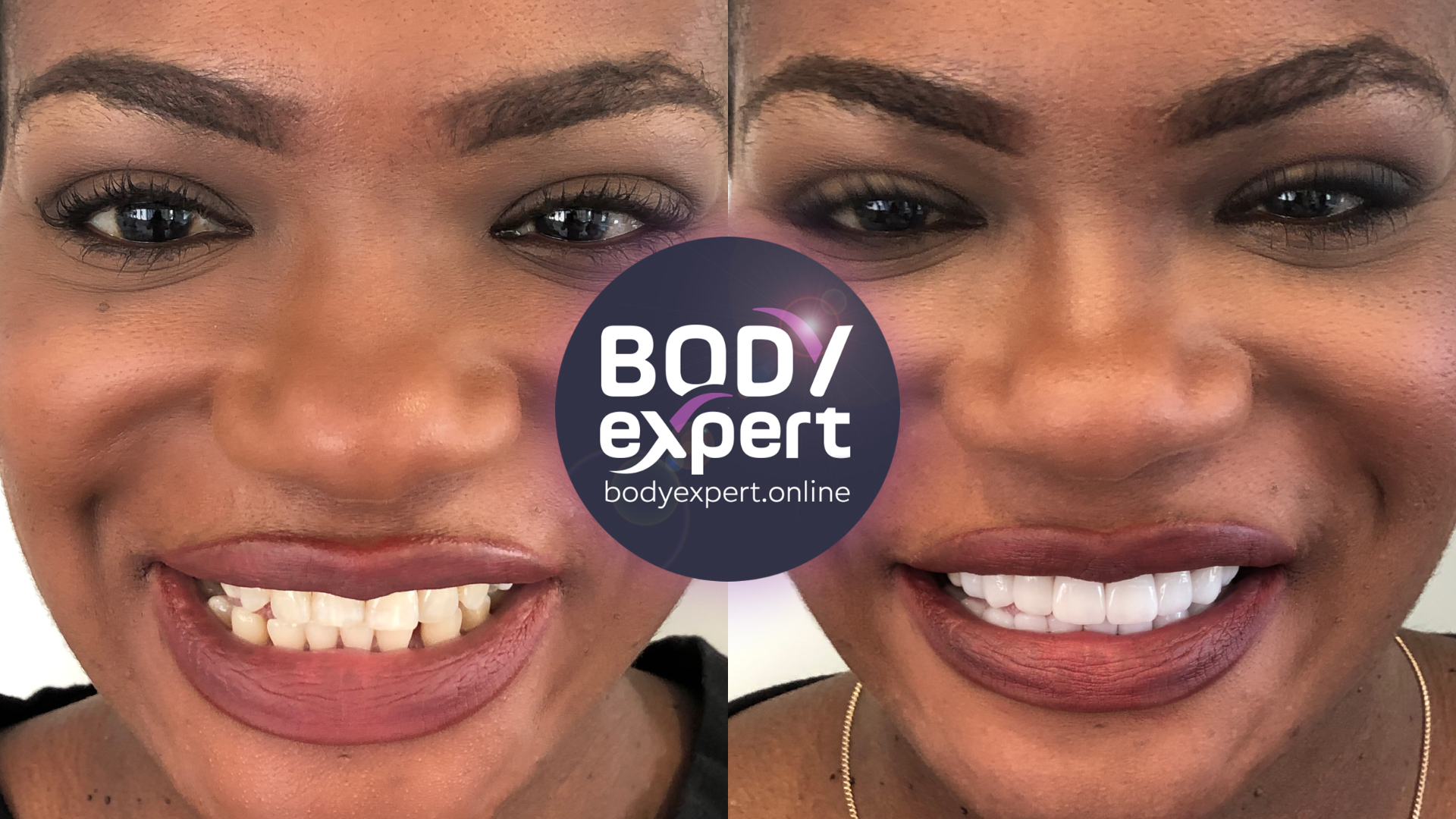 Before and after photographs of a female patient with defined eyebrows: protruding, uneven upper teeth, then a regular, bright row