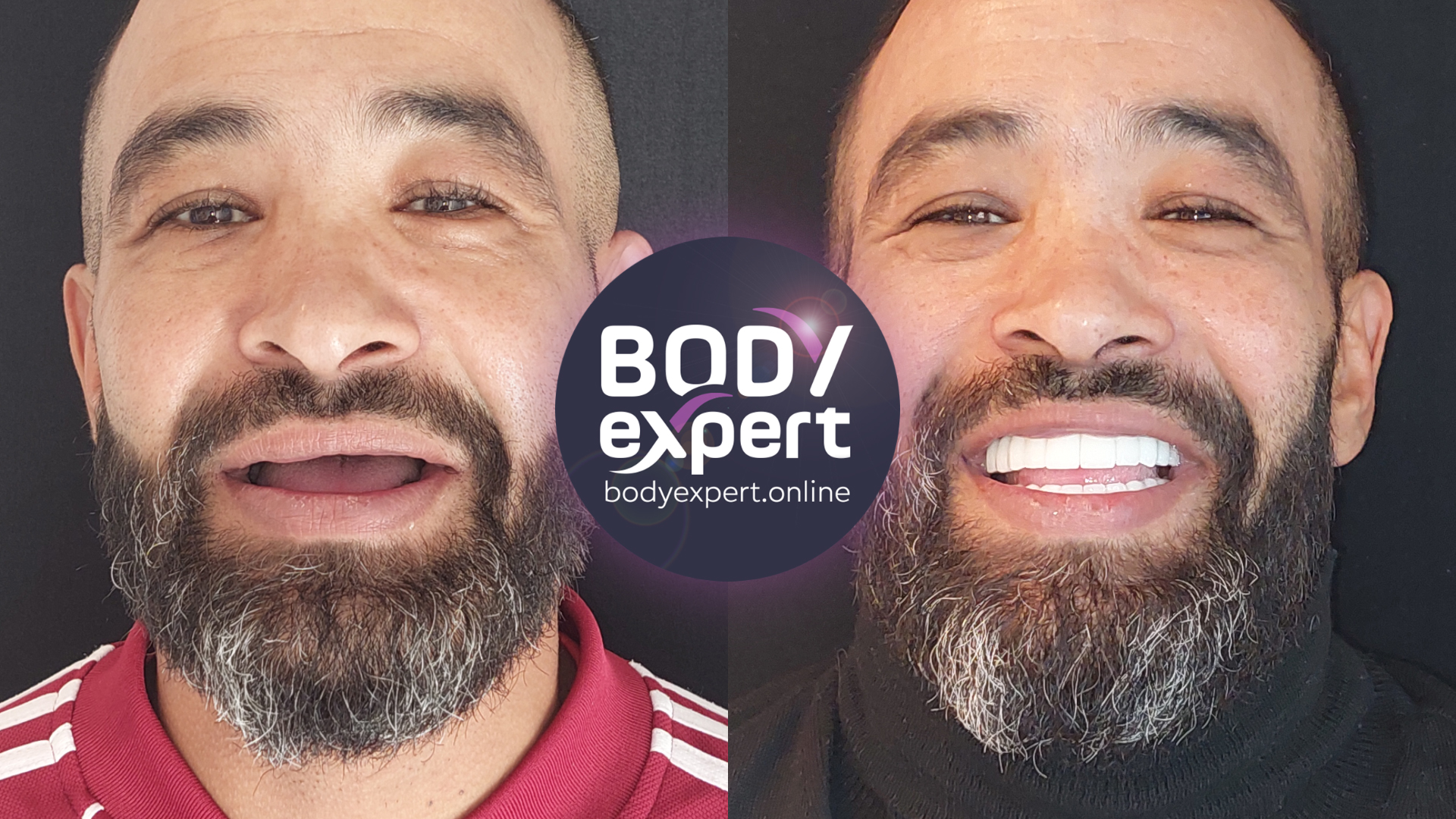 Vues avant et après d'un homme barbu : dents antérieures abîmées et irrégulières sur la première image, arcade complète et régulière sur la seconde
