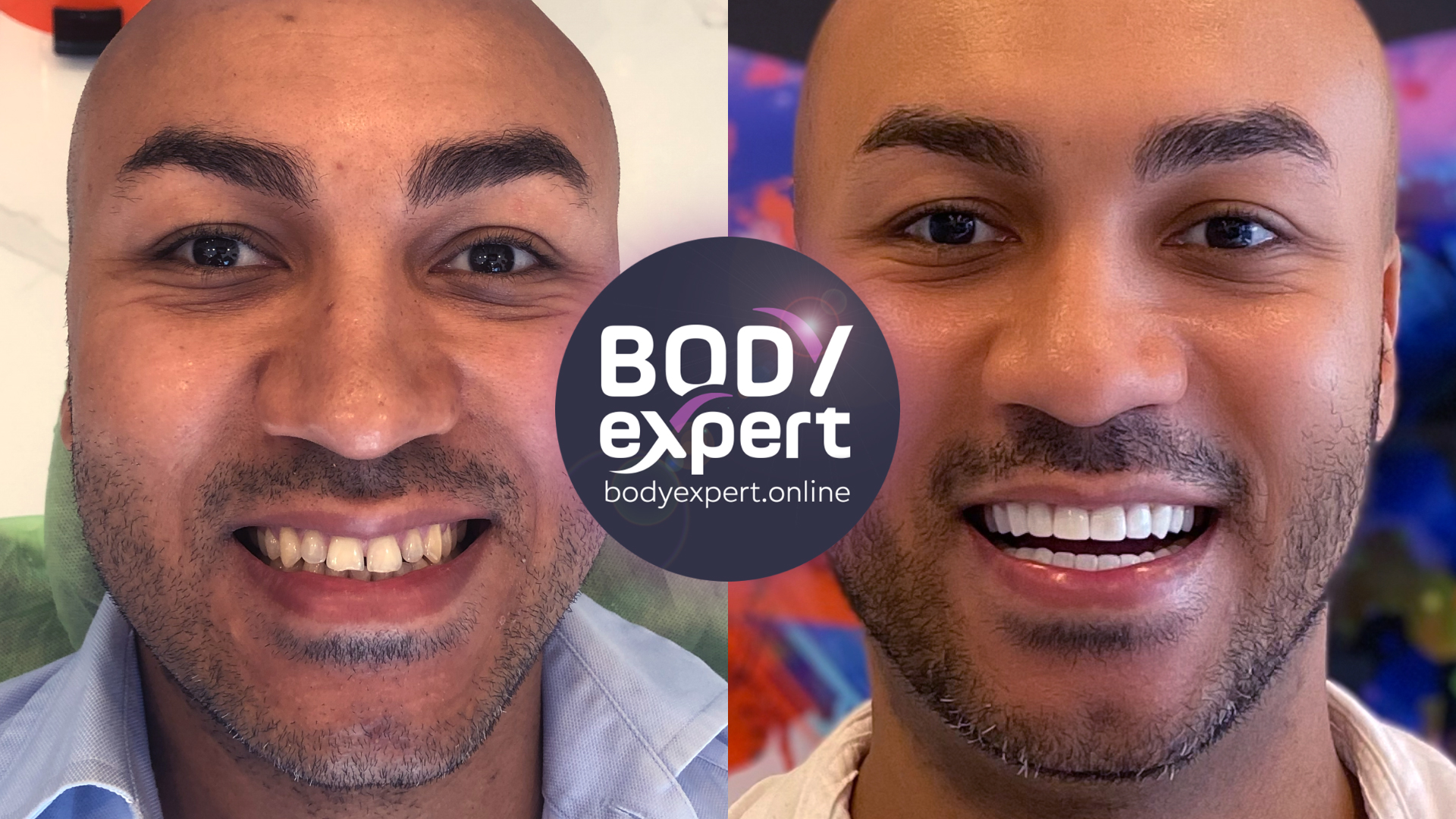 Before and after photographs of a bald male patient with a short beard: gapped, yellowed teeth, then an even, bright row