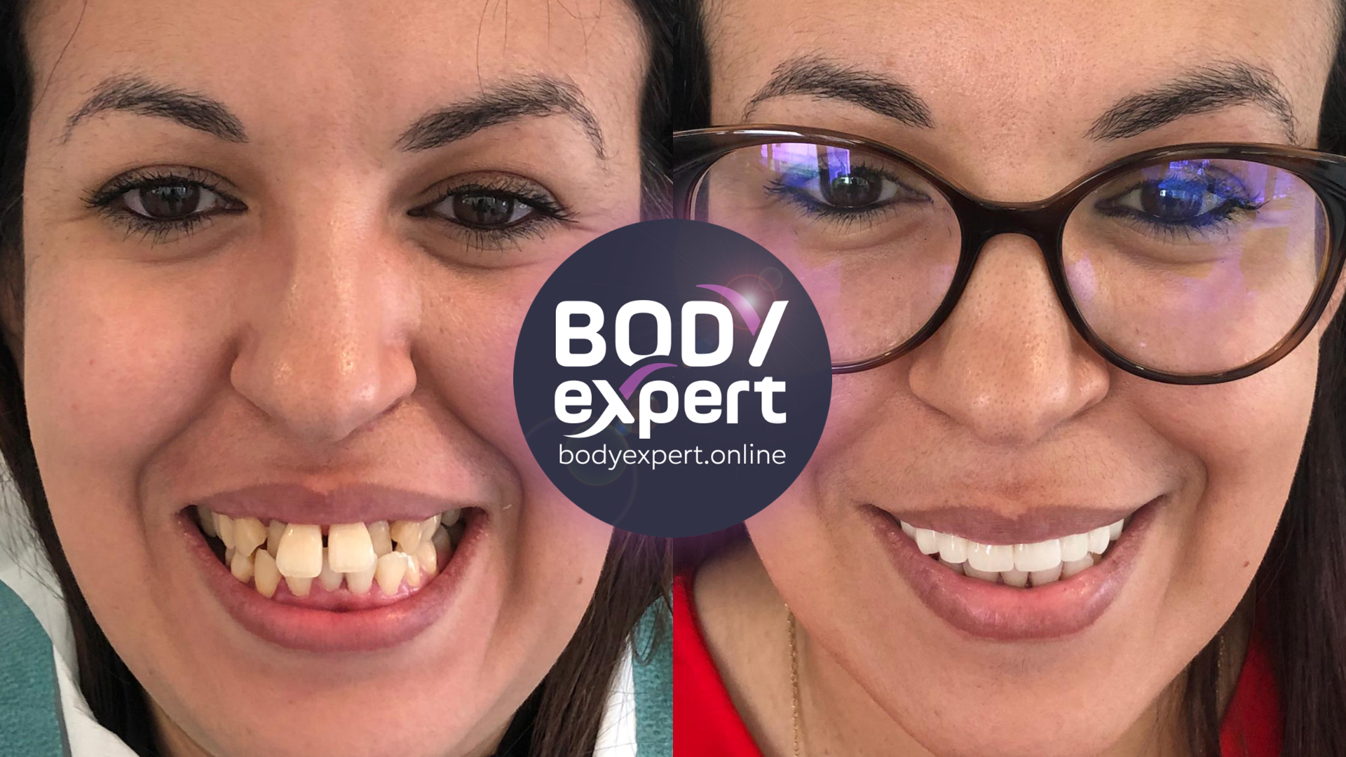 Vues avant et après d'une femme portant des lunettes : dents antérieures colorées et irrégulières sur la première image, sourire aligné et clair sur la seconde
