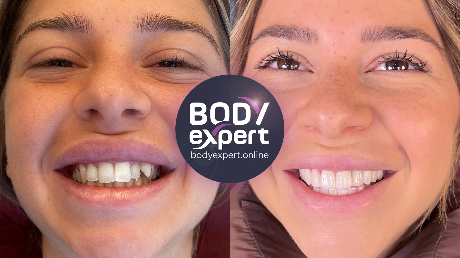 Before and after photographs of a young woman with freckles: chipped, uneven upper incisors, then a regular row