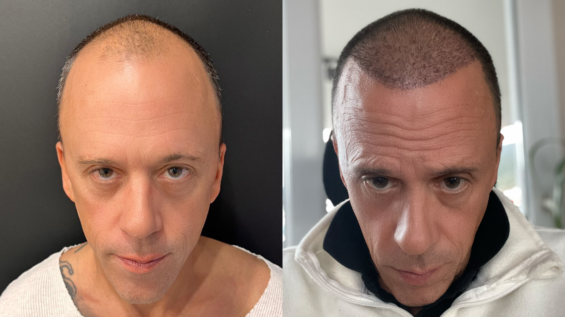 Deux portraits d’un homme aux cheveux clairsemés puis très courts