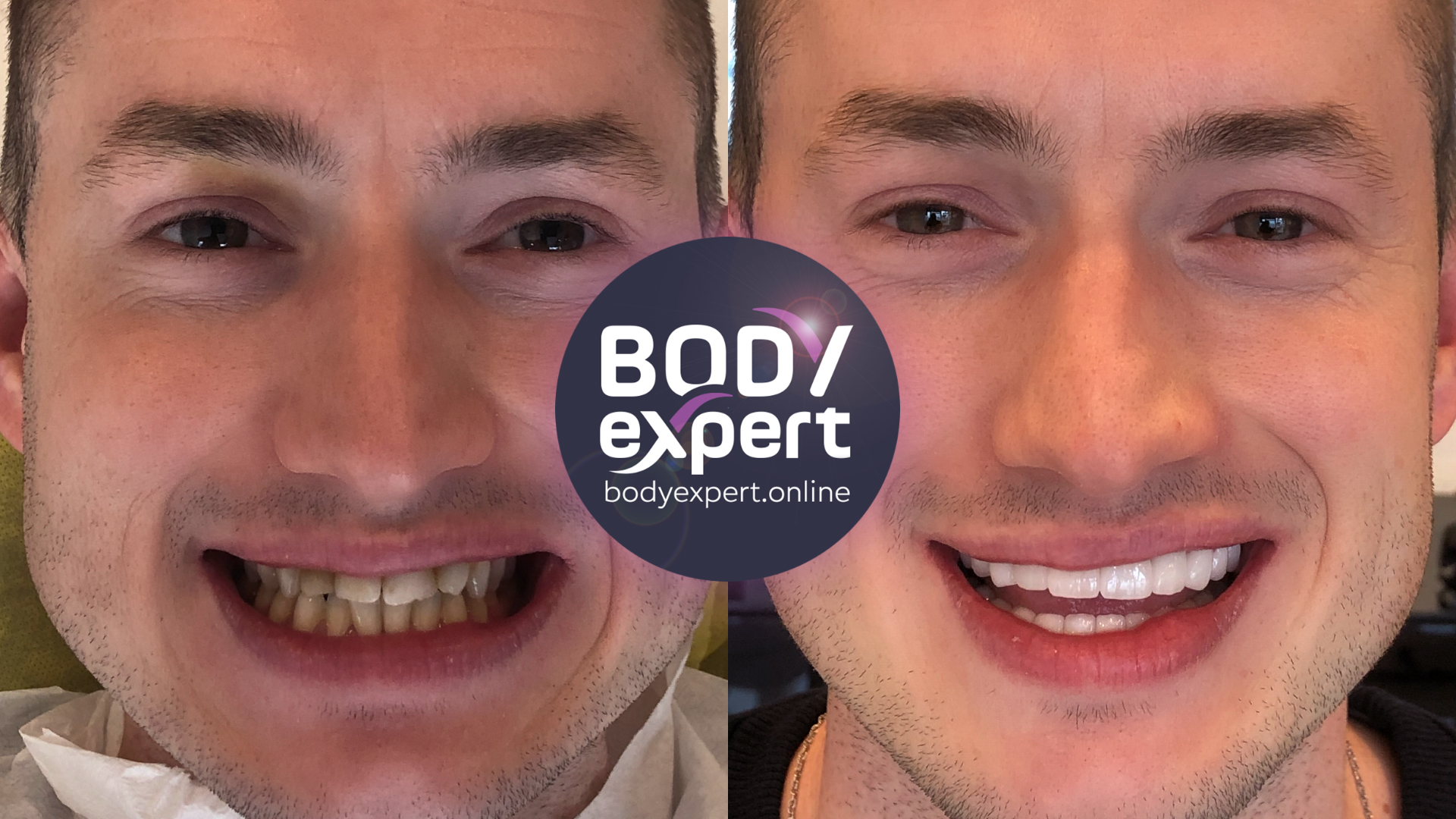 Before and after photographs of a male patient with light brown hair: irregular, discoloured teeth, then an aligned, lighter row