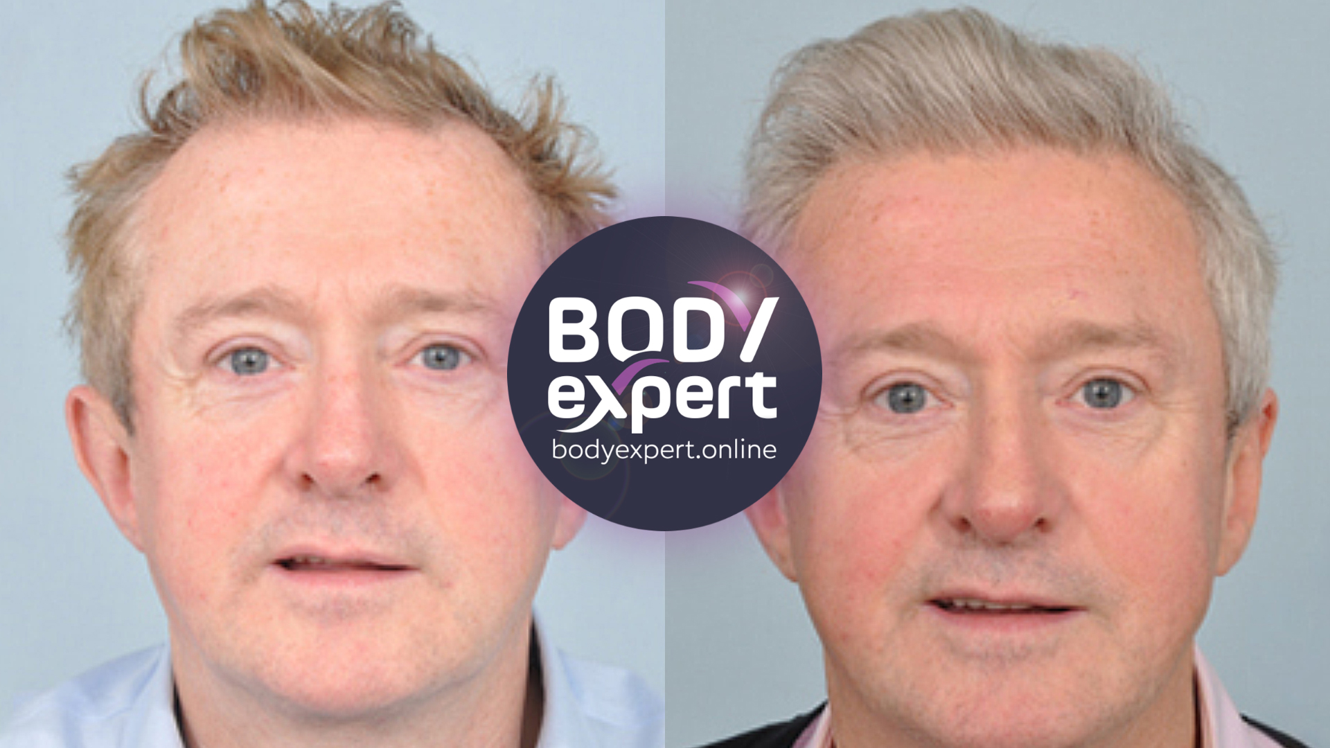 Side-by-side portraits of Louis Walsh, thinning fair hair on the left, a fuller hairline and smoother complexion on the right