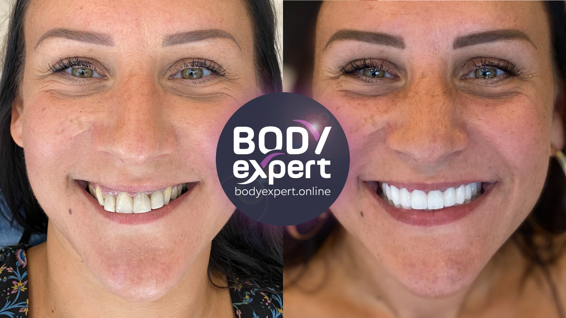 Before-and-after comparison of one woman's smile with the Body Expert logo in the centre