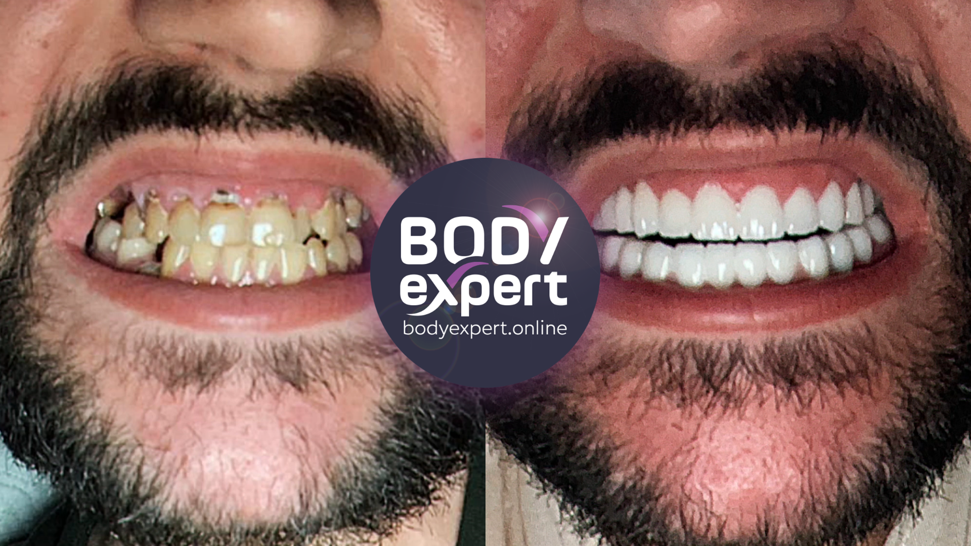 Before-and-after comparison of a man's smile with the Body Expert logo in the centre