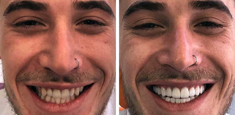 Sourire d’un homme moustachu, à gauche avant traitement avec des dents jaunies et irrégulières, à droite après avec des dents blanches et alignées