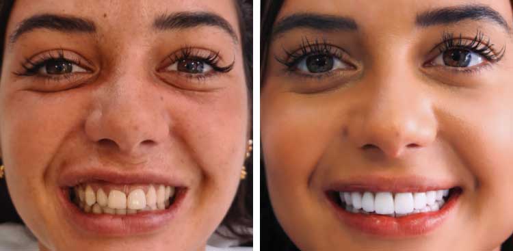 Sourire d’une femme brune, à gauche avant traitement avec des dents beiges et serrées, à droite après avec des dents claires et régulières