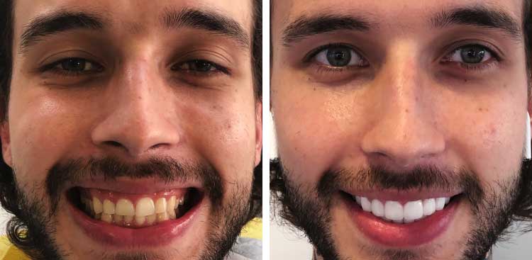 Sourire d’un homme barbu, à gauche avant traitement avec des dents jaunies et chevauchées, à droite après avec des dents blanches et harmonisées