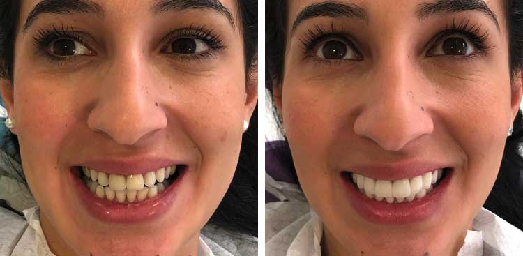 Sourire d’une femme au fauteuil, à gauche avant traitement avec des dents ternes et inégales, à droite après avec des dents blanches et alignées