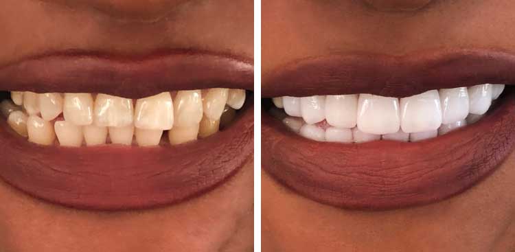 Gros plan d’une bouche, à gauche avant traitement avec des dents écartées et usées, à droite après avec des dents jointives et uniformes