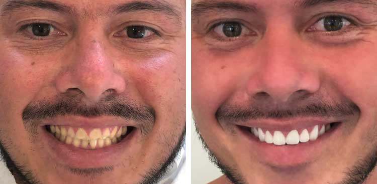 Sourire d’un homme barbu, à gauche avant traitement avec des dents jaunies et courtes, à droite après avec des dents blanches et redessinées