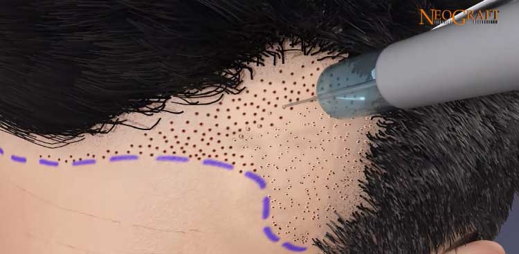 Illustration of a NeoGraft instrument beside a marked donor scalp