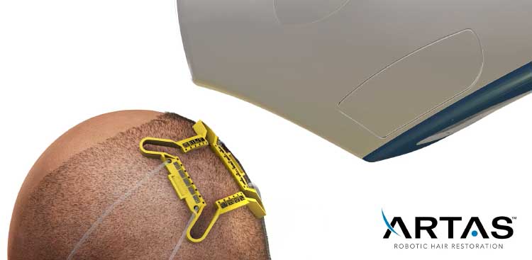 Illustration of an ARTAS device above a scalp with a yellow positioning frame