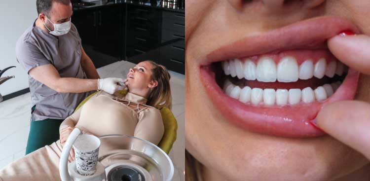 Diptych: the masked and gloved dental surgeon examining Kay in the chair, then a close-up of her smile with the lip retracted, showing her veneers on the upper and lower arches