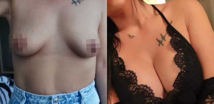 Before and after comparison for Océanie: the bust from the front before the procedure, then in a lace bralette afterwards, with intimate areas blurred