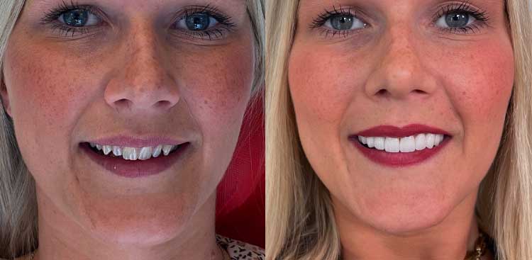 Close-up of Marie’s smile before and after her dental treatment