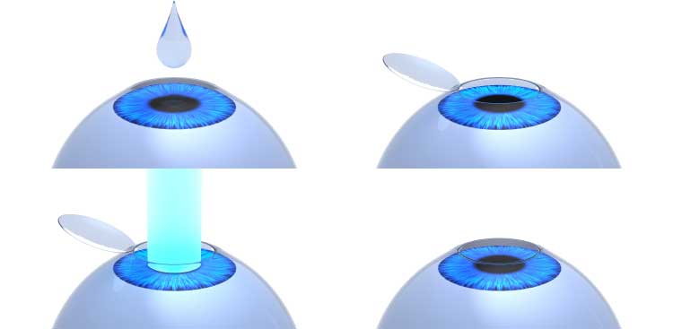 Simplified diagram showing the stages of a corneal treatment