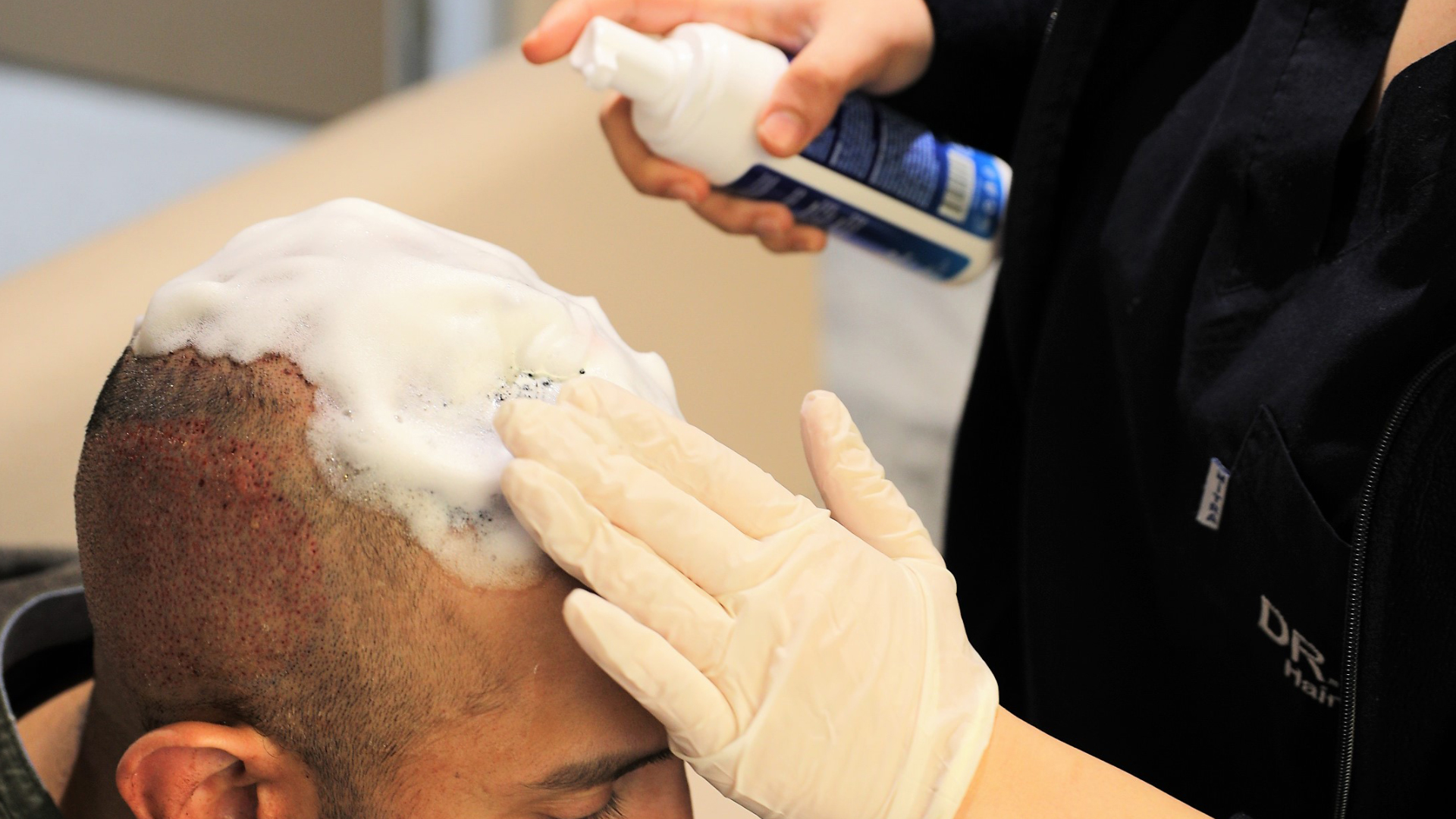 Mousse appliquée sur le cuir chevelu d’un patient avec des mains gantées