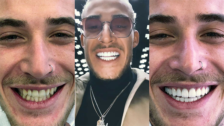 Triptych of the smile of Théo Simonin, known as Simo: his teeth before fitting, a smiling portrait in sunglasses, then the same smile with his veneers