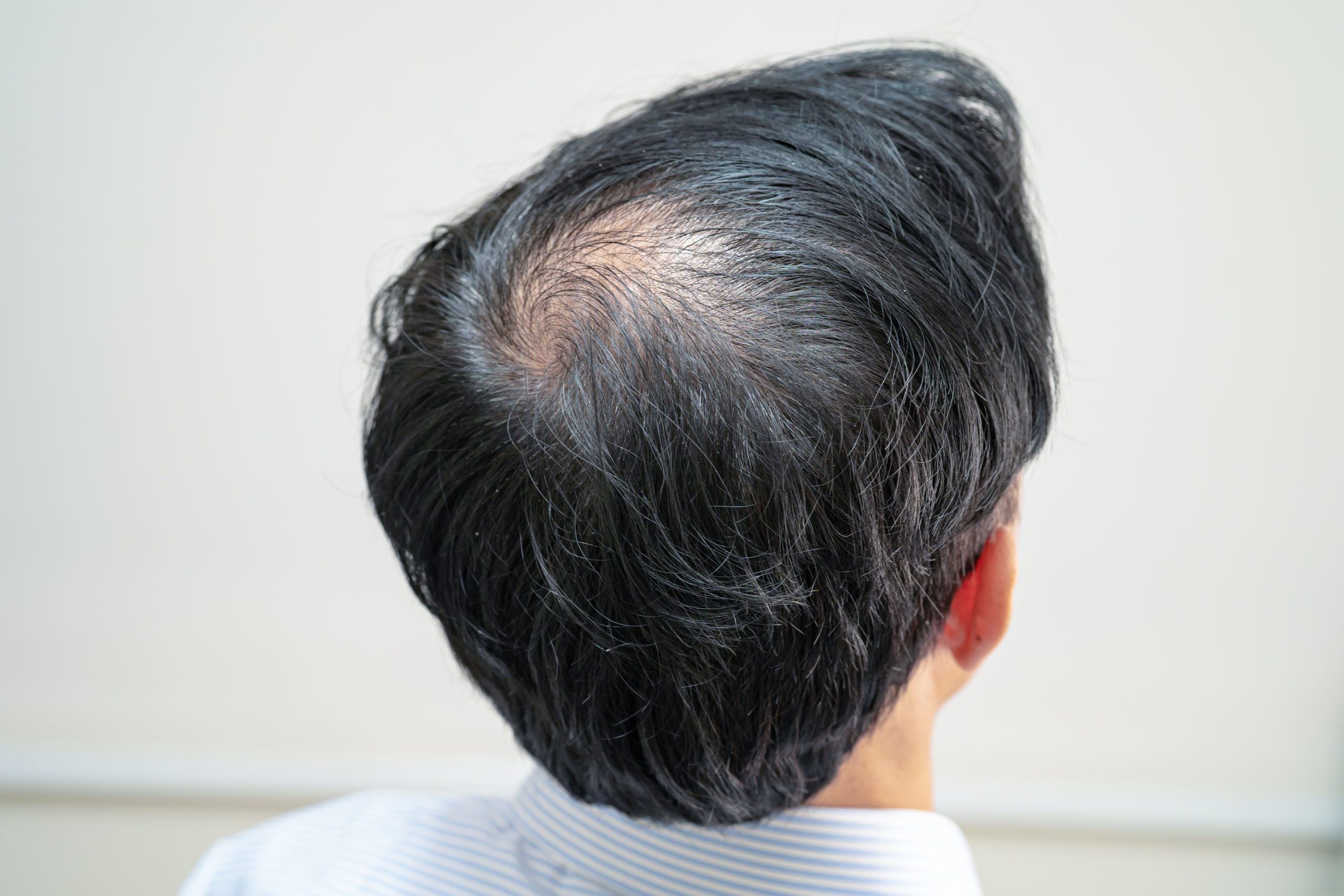 Rear view of the crown of a head with black and gray hair thinning around the vertex.