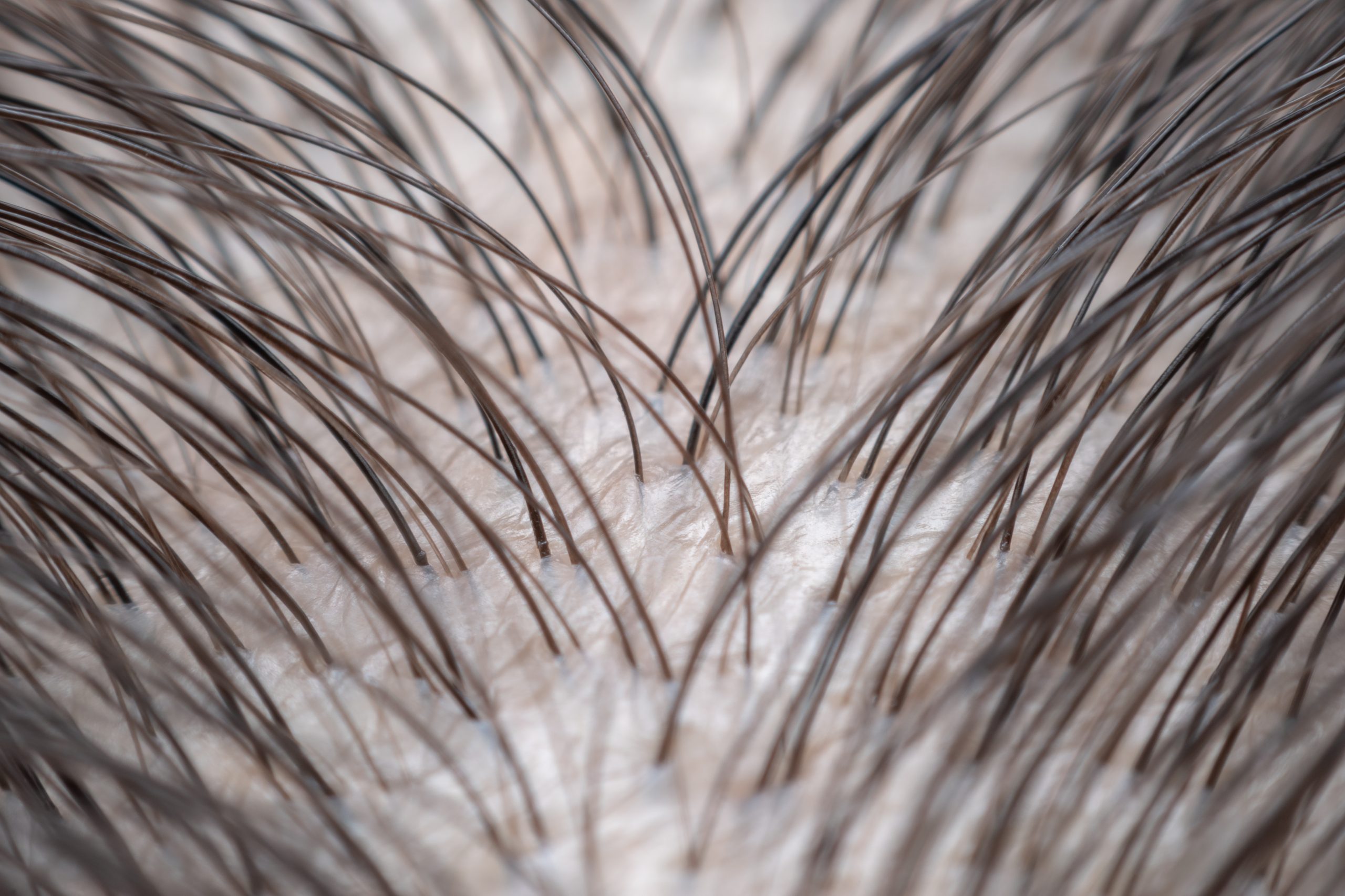 Macro view of hairs emerging from the scalp at different angles, with skin visible between the strands.