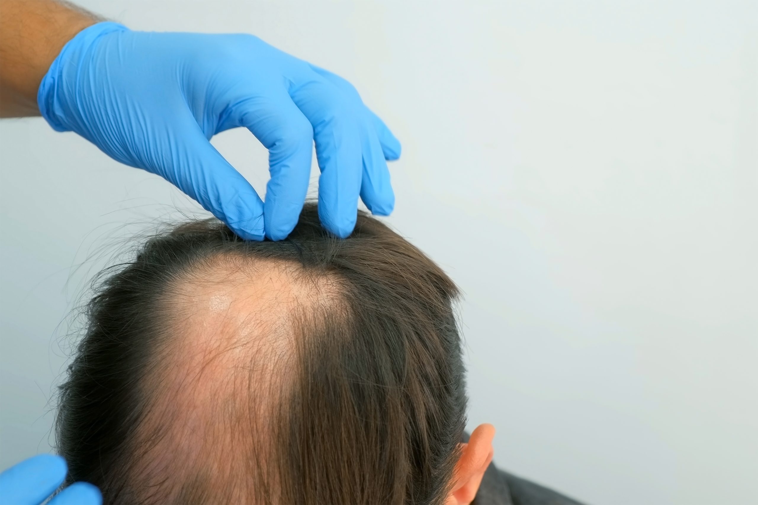 Blue-gloved hands part the hair to examine a thinning area of the scalp.