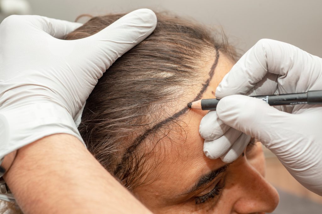 Gloved hands hold the hair back and draw a pencil line on the forehead along the hairline.