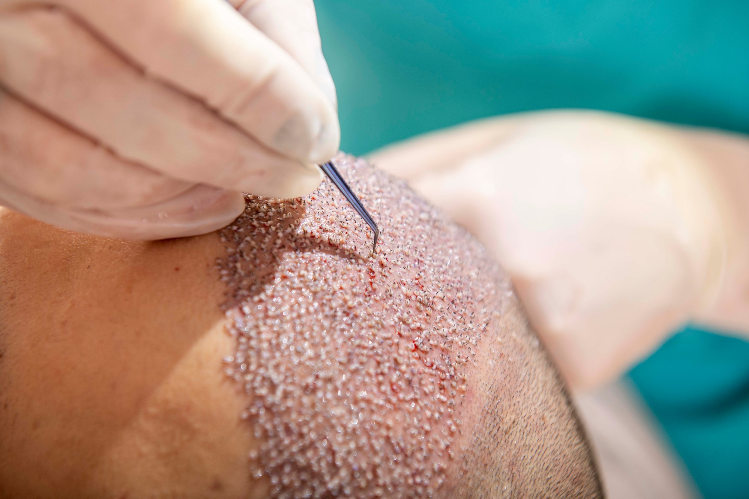 Close-up of a gloved hand handling a fine instrument on a shaved scalp with small traces of blood.