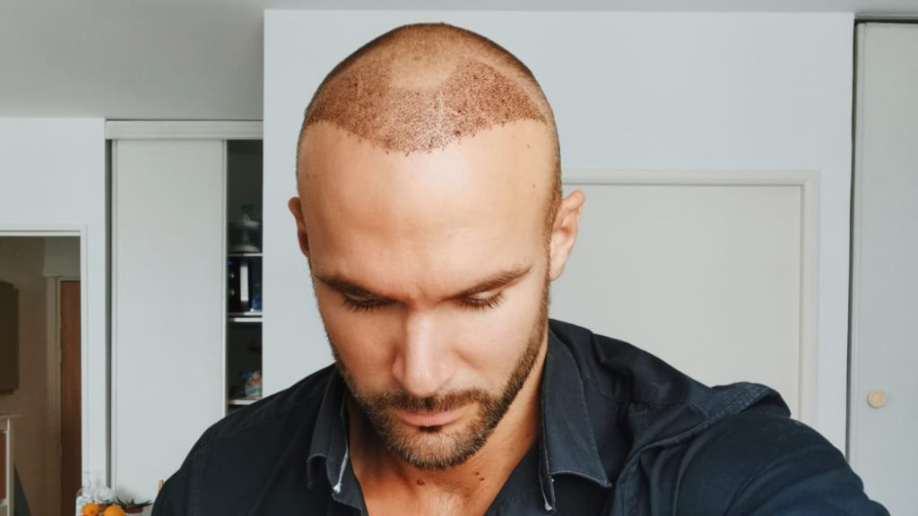 Man tilting his head down, with small reddish-brown scabs visible on the front of his closely shaved scalp.