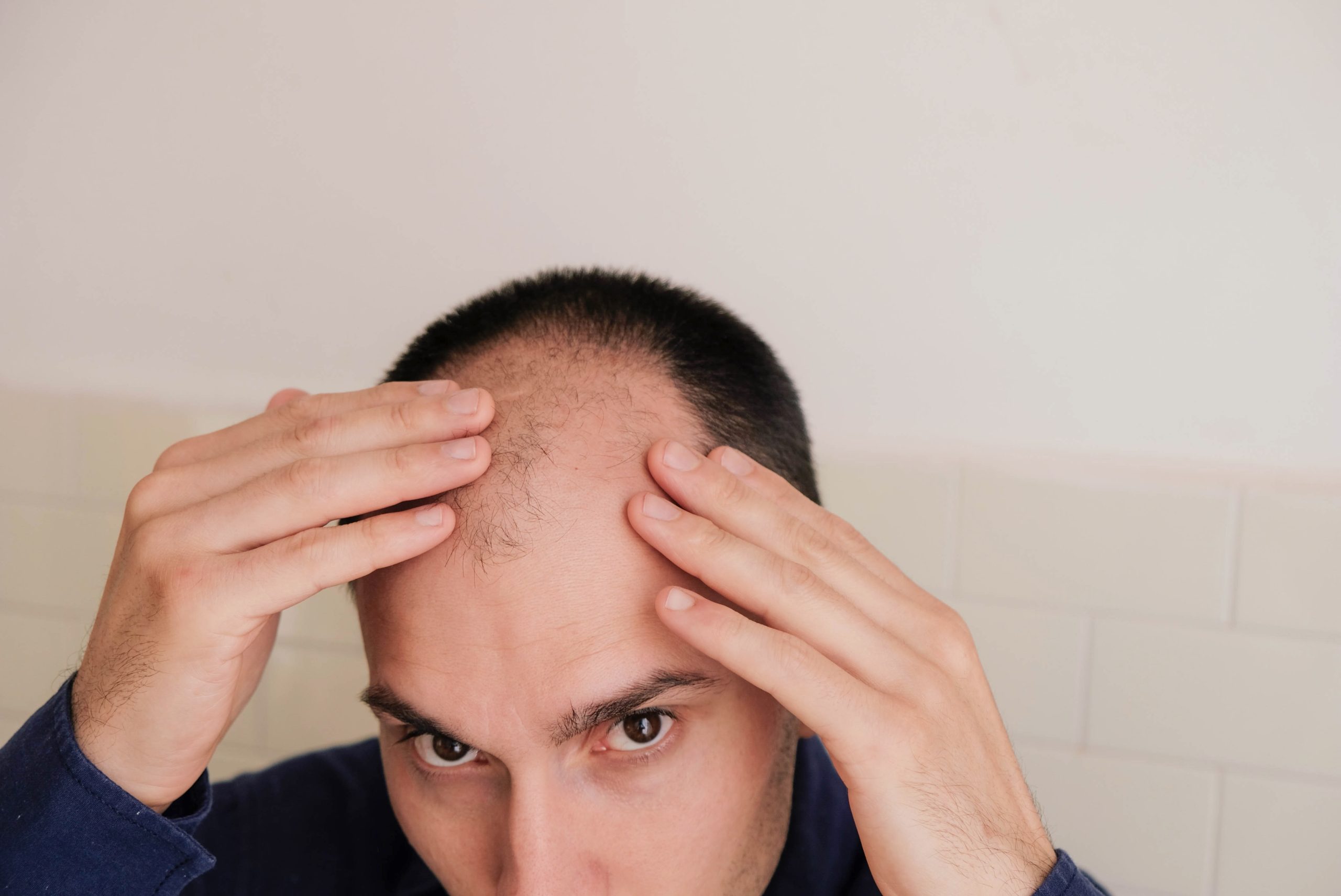 Man placing his hands on either side of his forehead, with thinning hair at the front of his scalp.