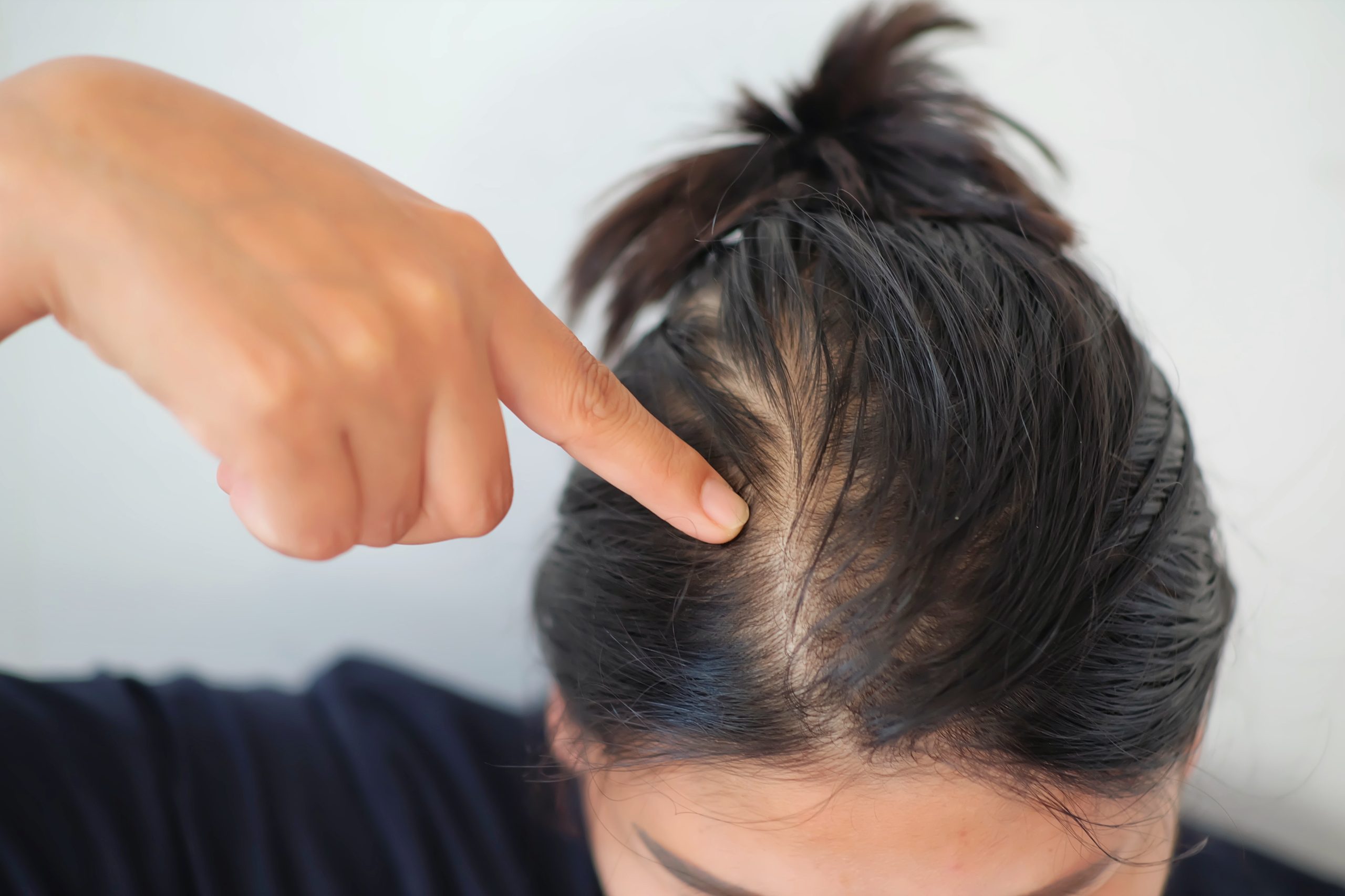 Close-up of a person with tied-back hair pointing to the scalp visible along their parting.